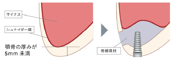 サイナスリフト